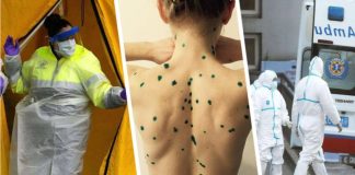 Роспотребнадзор выявил оспу обезьян у туристов: они изолированы, началось эпидемиологическое расследование