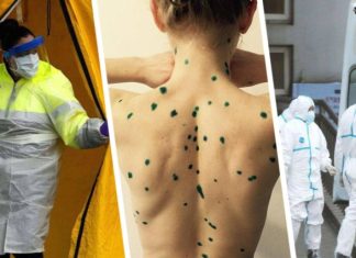 Роспотребнадзор выявил оспу обезьян у туристов: они изолированы, началось эпидемиологическое расследование