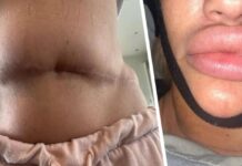 «Искалеченные и оставленные гнить»: туристов, ищущих недорогую операцию в Турции, предупреждают, что их отправят домой больными, обезображенными и на грани смерти