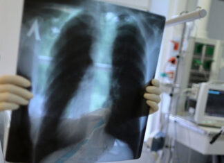 Мир вновь оказался во власти туберкулеза