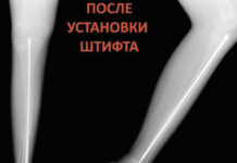 Врачам удалось укрепить кости ребенка с редким заболеванием