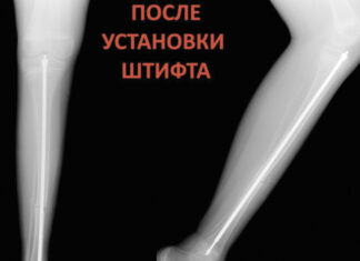 Врачам удалось укрепить кости ребенка с редким заболеванием