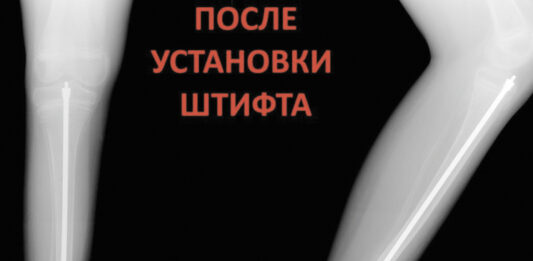 Врачам удалось укрепить кости ребенка с редким заболеванием